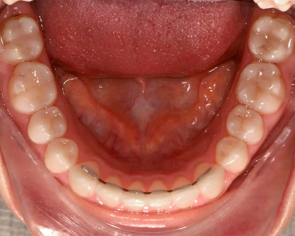 Перекрестный прикус - Кейс 2 — нижняя челюсть после лечения