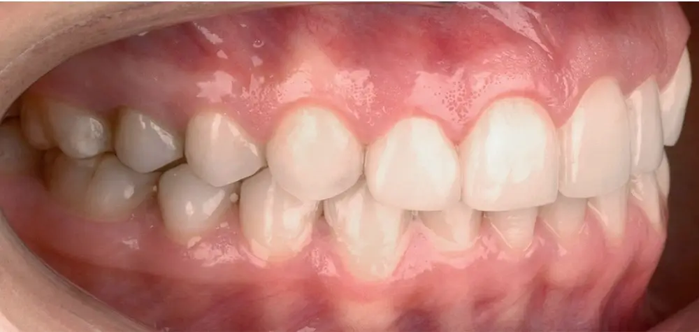 Перекрестный прикус - Кейс 2 — боковой ракурс после лечения