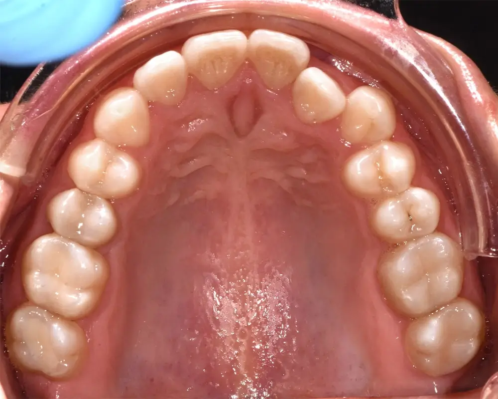 Перекрестный прикус - Кейс 2 — верхняя челюсть до лечения