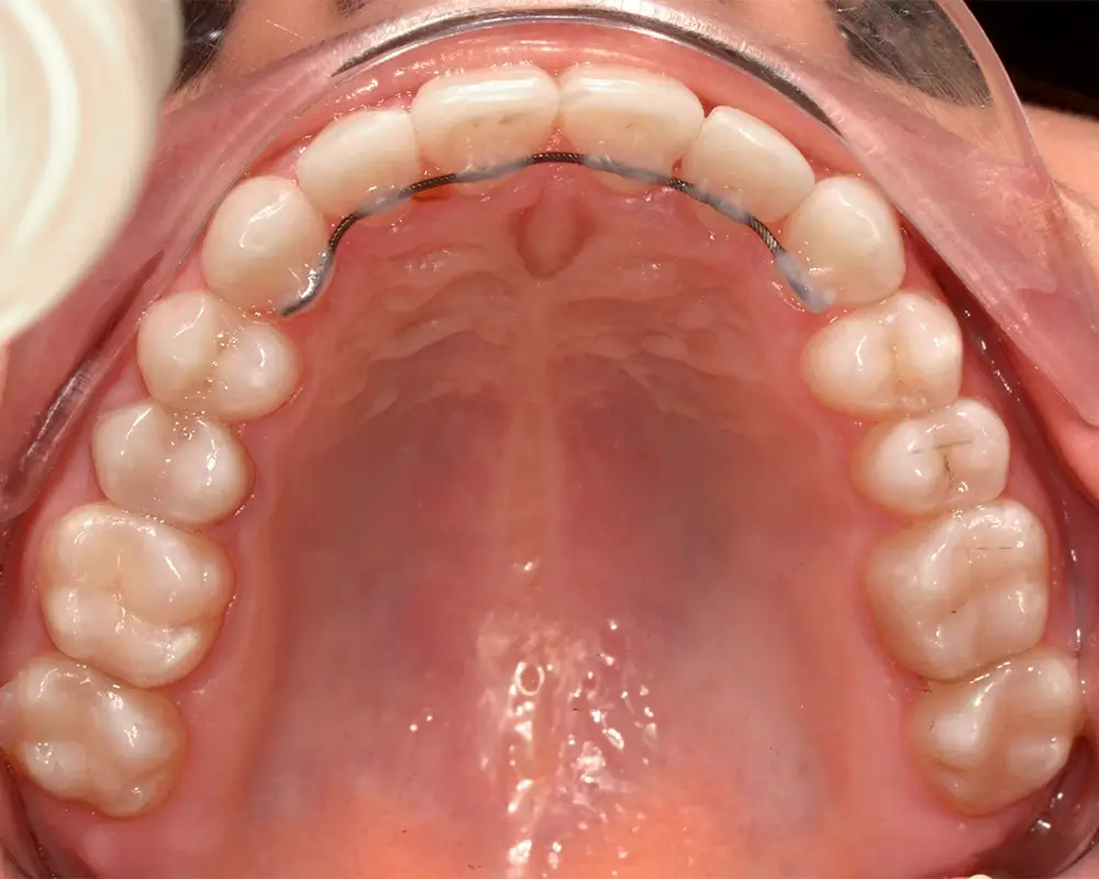 Перекрестный прикус - Кейс 2 — верхняя челюсть после лечения