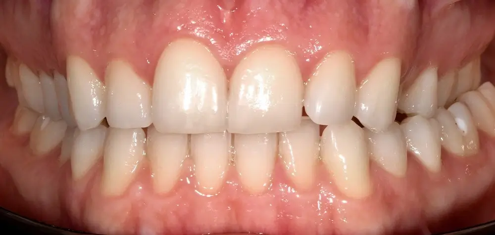 Перекрестный прикус - Кейс 3 — вид спереди до лечения