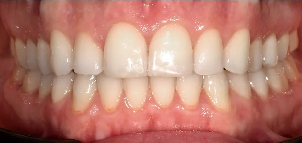 Перекрестный прикус - Кейс 3 — вид спереди после лечения