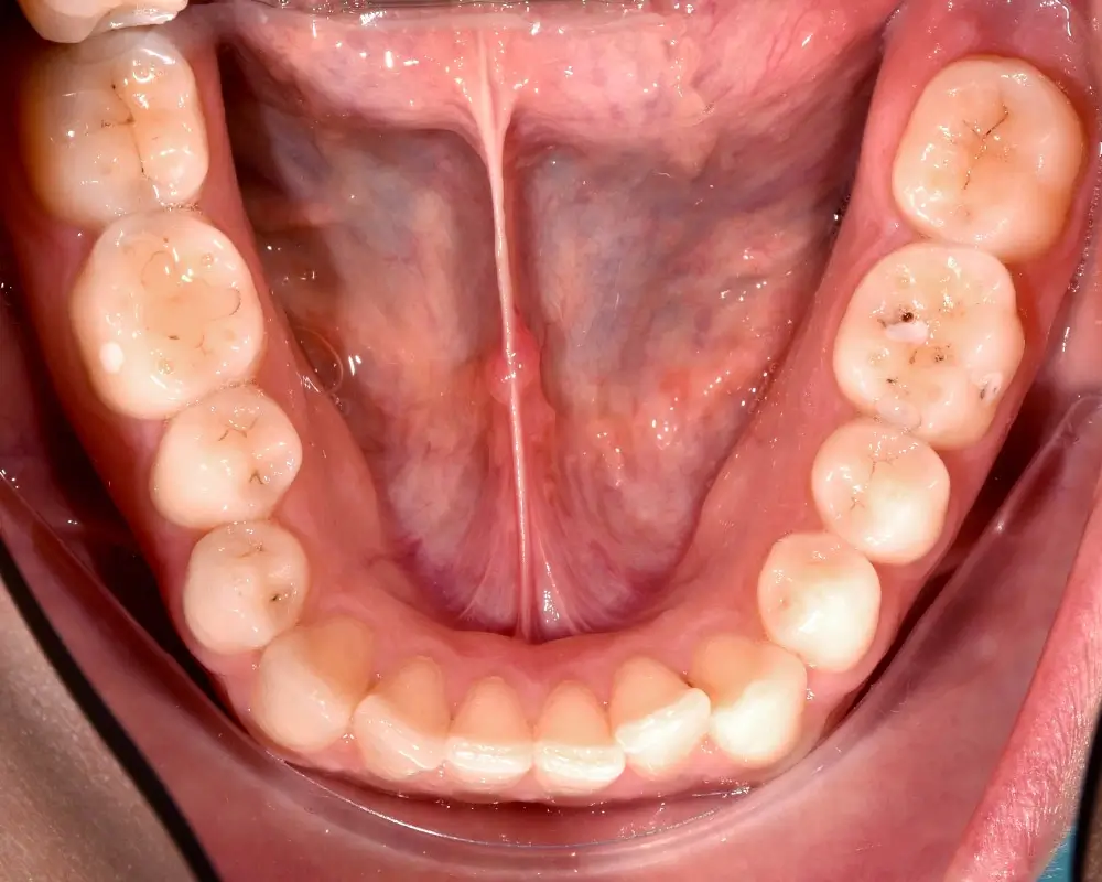 Перекрестный прикус - Кейс 3 — нижняя челюсть до лечения