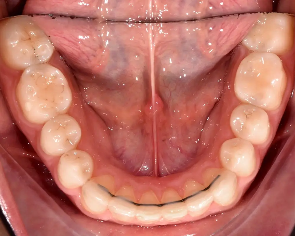 Перекрестный прикус - Кейс 3 — нижняя челюсть после лечения