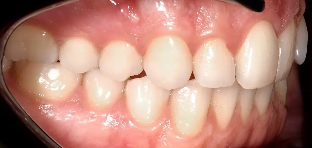 Перекрестный прикус - Кейс 3 — боковой ракурс до лечения