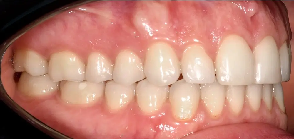 Перекрестный прикус - Кейс 3 — боковой ракурс после лечения