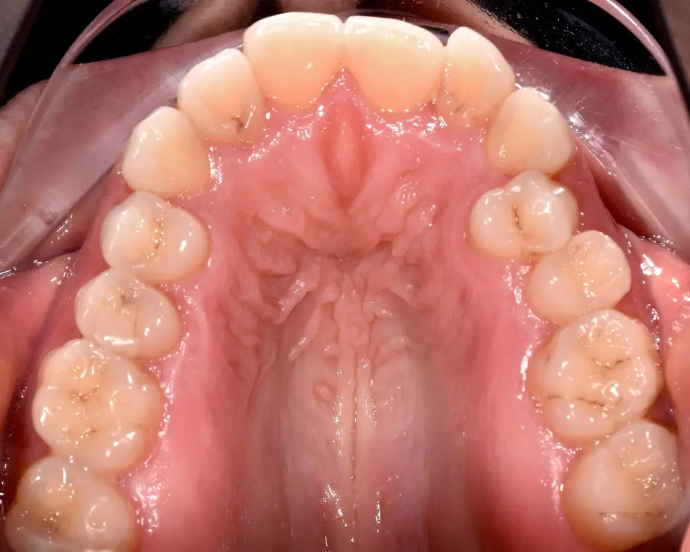 Перекрестный прикус - Кейс 3 — верхняя челюсть до лечения