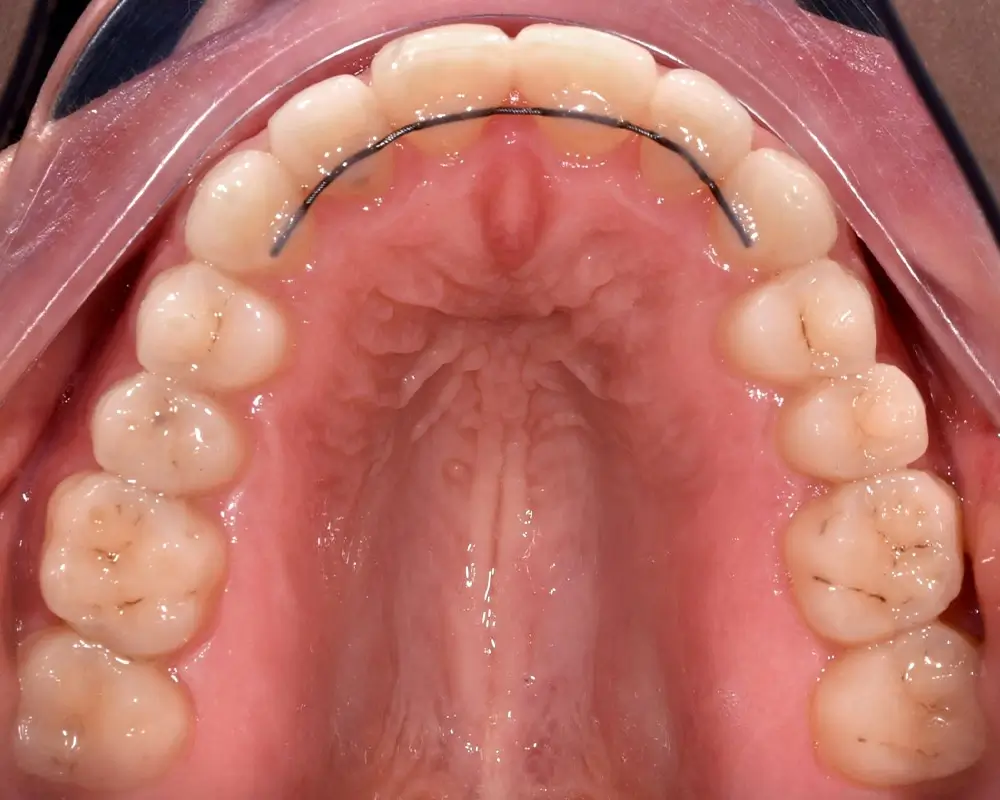 Перекрестный прикус - Кейс 3 — верхняя челюсть после лечения