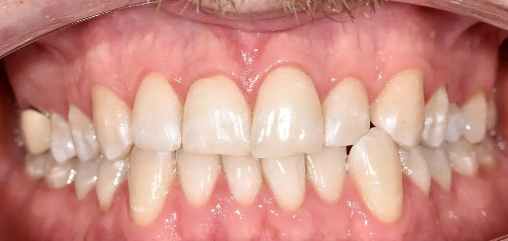 Перекрестный прикус - Кейс 4 — вид спереди до лечения