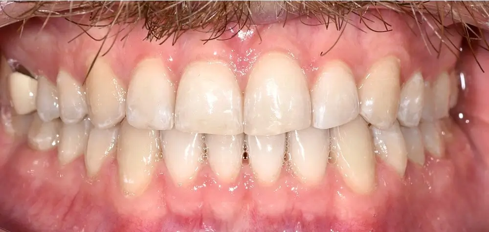 Перекрестный прикус - Кейс 4 — вид спереди после лечения