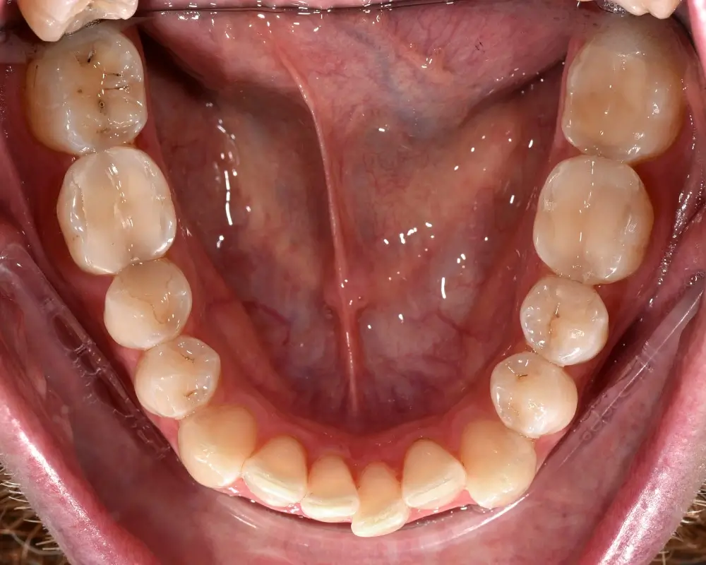 Перекрестный прикус - Кейс 4 — нижняя челюсть до лечения