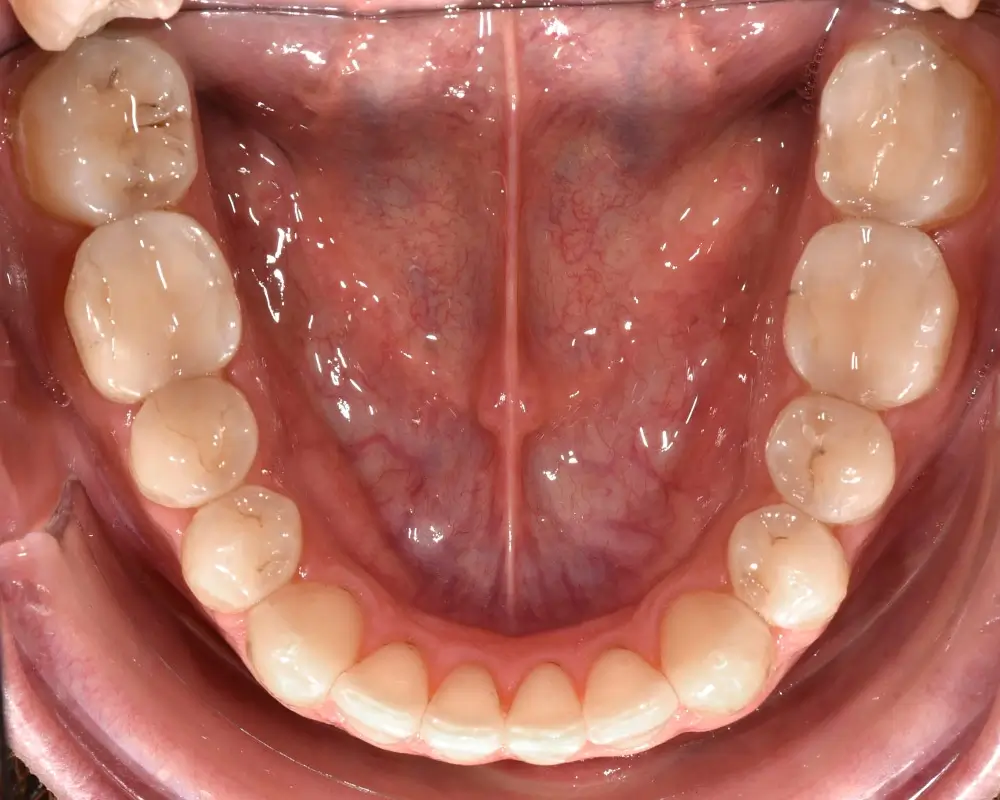 Перекрестный прикус - Кейс 4 — нижняя челюсть после лечения