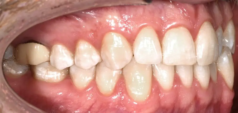 Перекрестный прикус - Кейс 4 — боковой ракурс до лечения