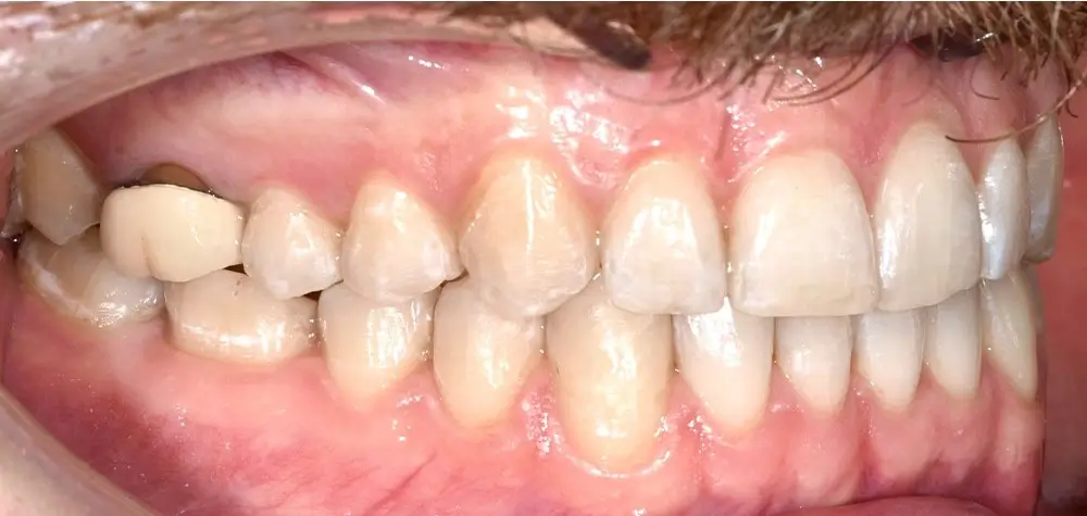 Перекрестный прикус - Кейс 4 — боковой ракурс после лечения