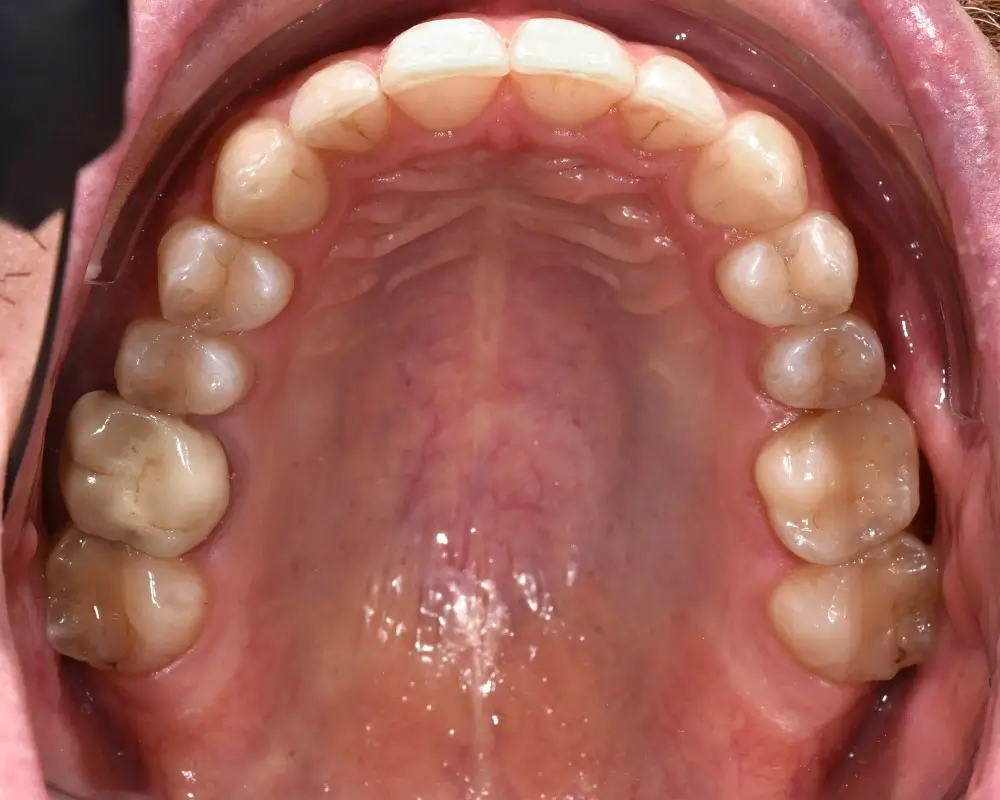 Перекрестный прикус - Кейс 4 — верхняя челюсть после лечения