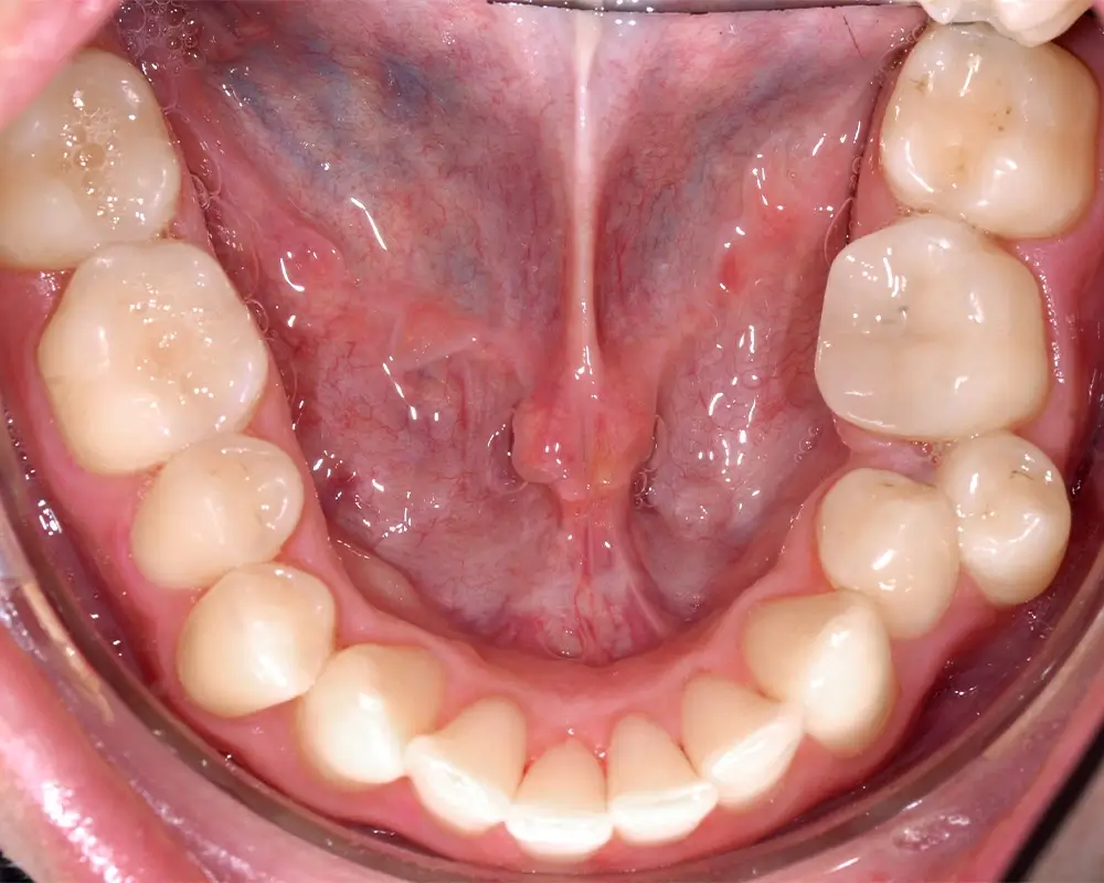 Перекрестный прикус - Кейс 5 — нижняя челюсть до лечения