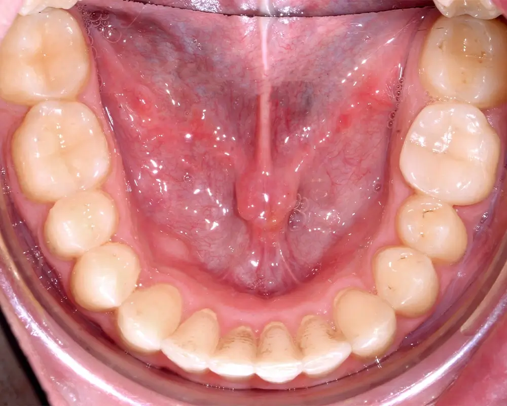Перекрестный прикус - Кейс 5 — нижняя челюсть после лечения