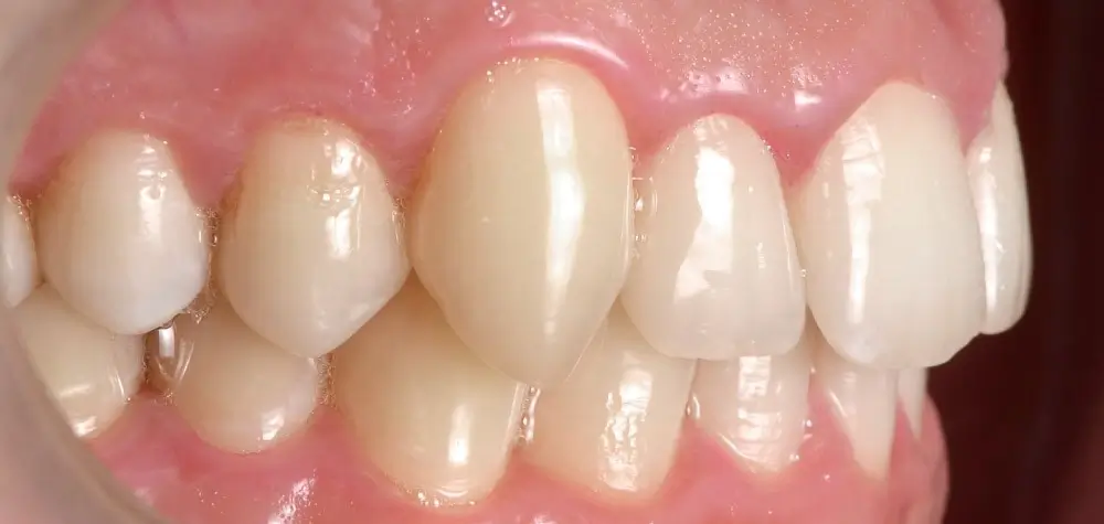 Перекрестный прикус - Кейс 5 — боковой ракурс до лечения