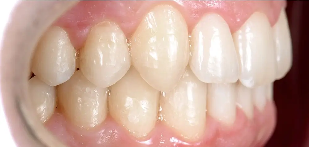 Перекрестный прикус - Кейс 5 — боковой ракурс после лечения