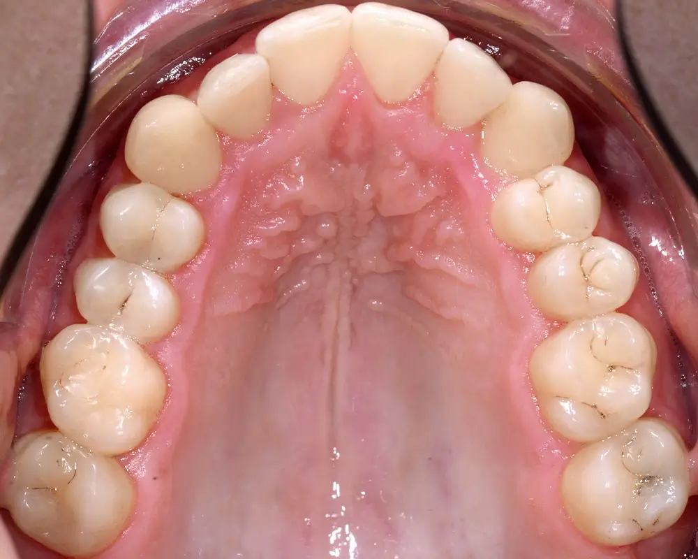 Перекрестный прикус - Кейс 5 — верхняя челюсть до лечения