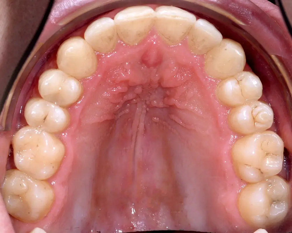 Перекрестный прикус - Кейс 5 — верхняя челюсть после лечения