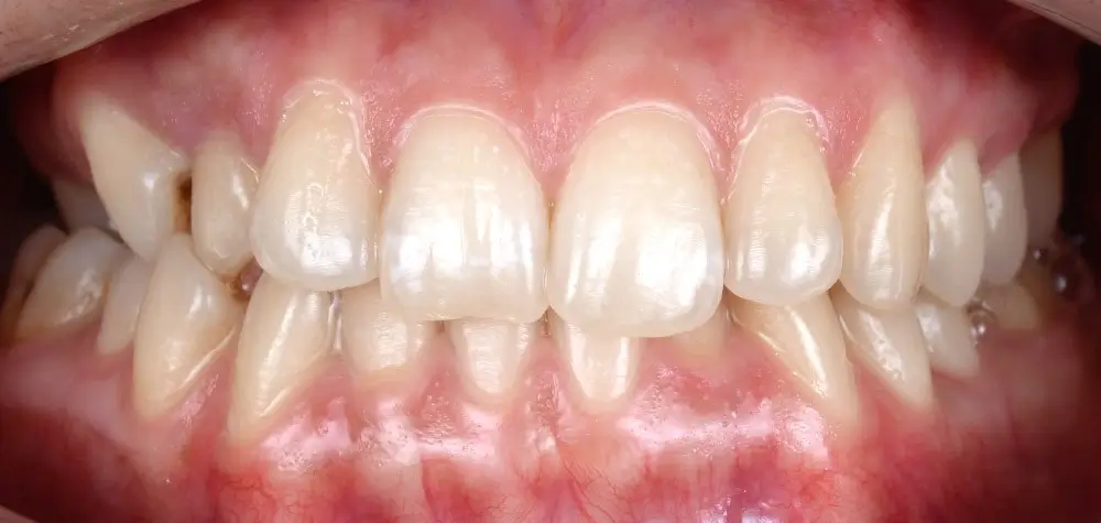 Перекрестный прикус - Кейс 6 — вид спереди до лечения