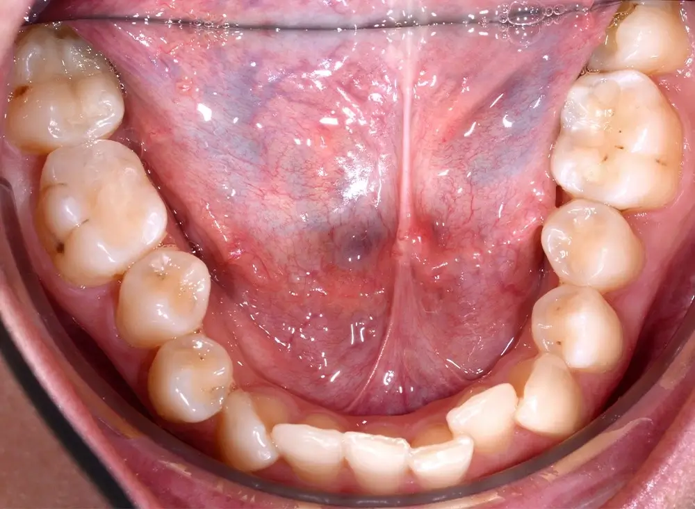 Перекрестный прикус - Кейс 6 — нижняя челюсть до лечения