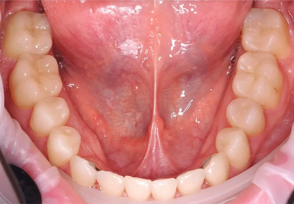 Перекрестный прикус - Кейс 6 — нижняя челюсть после лечения