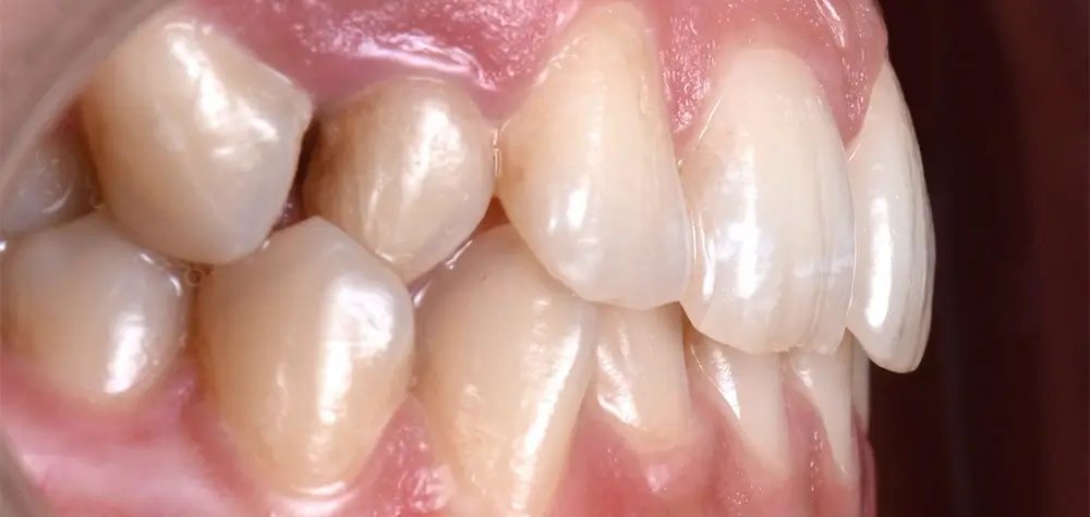 Перекрестный прикус - Кейс 6 — боковой ракурс до лечения