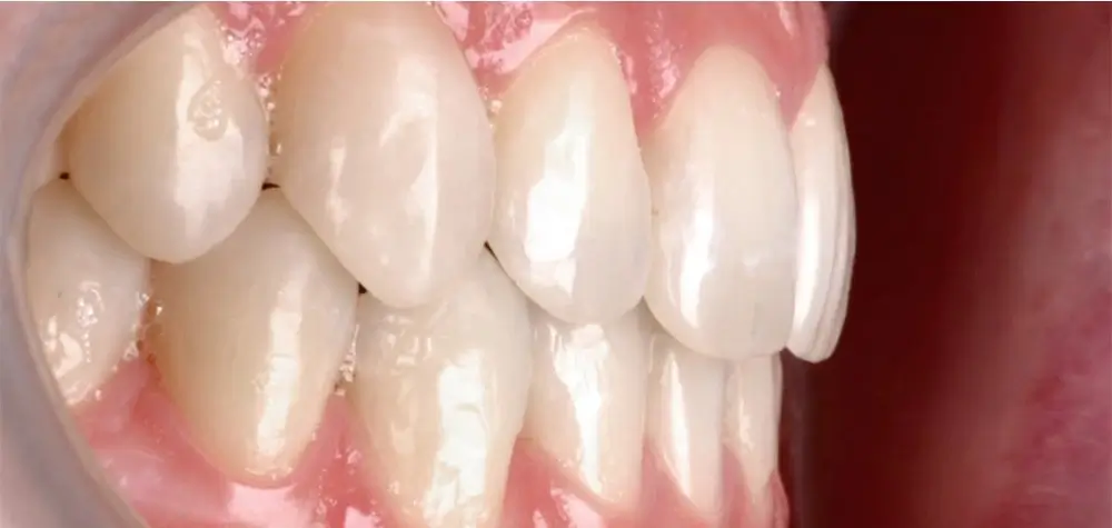 Перекрестный прикус - Кейс 6 — боковой ракурс после лечения