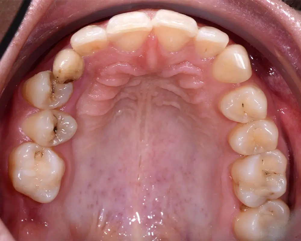 Перекрестный прикус - Кейс 6 — верхняя челюсть до лечения