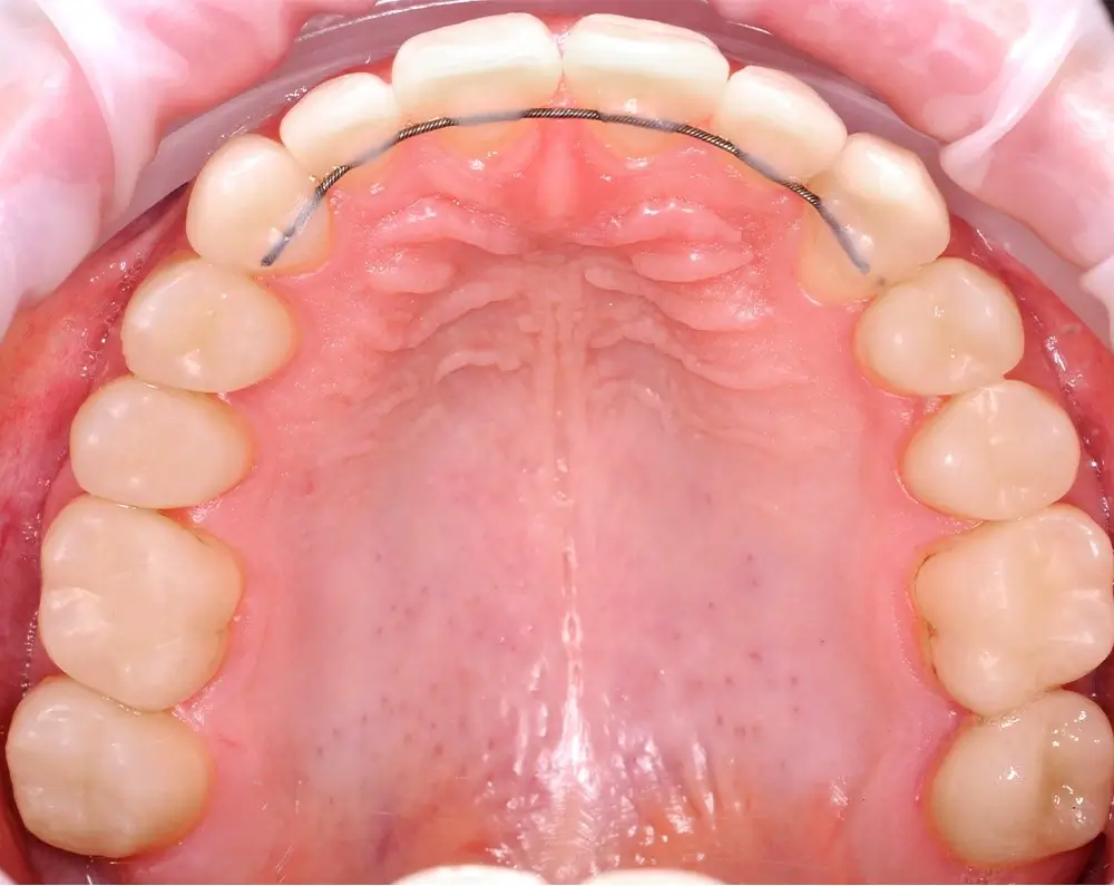 Перекрестный прикус - Кейс 6 — верхняя челюсть после лечения