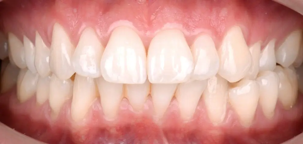 Перекрестный прикус - Кейс 7 — вид спереди до лечения