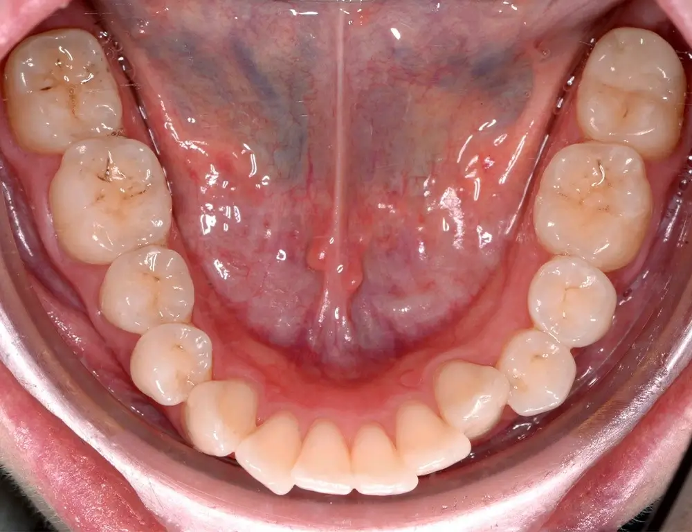 Перекрестный прикус - Кейс 7 — нижняя челюсть до лечения