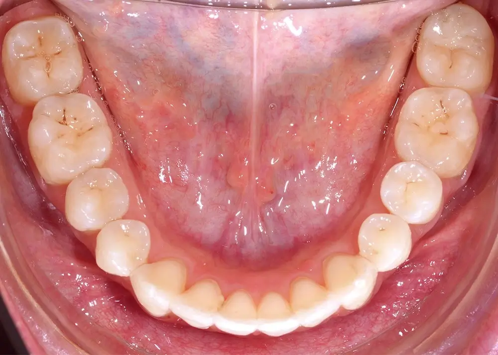 Перекрестный прикус - Кейс 7 — нижняя челюсть после лечения