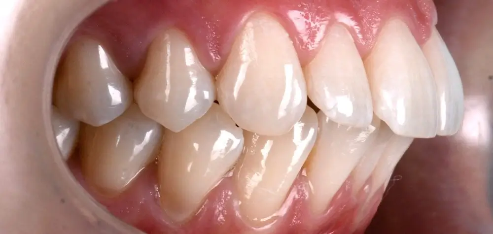 Перекрестный прикус - Кейс 7 — боковой ракурс до лечения