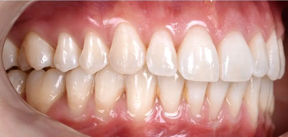 Перекрестный прикус - Кейс 7 — боковой ракурс после лечения