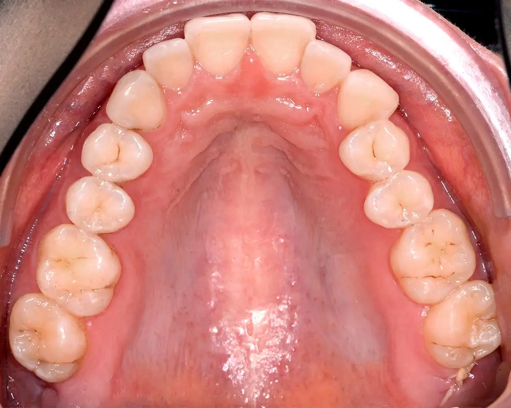 Перекрестный прикус - Кейс 7 — верхняя челюсть до лечения