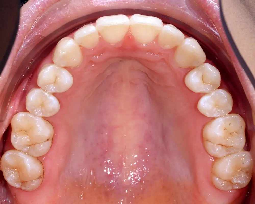 Перекрестный прикус - Кейс 7 — верхняя челюсть после лечения