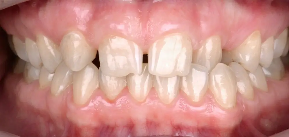 Перекрестный прикус - Кейс 8 — вид спереди до лечения