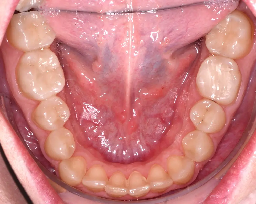 Перекрестный прикус - Кейс 8 — нижняя челюсть до лечения