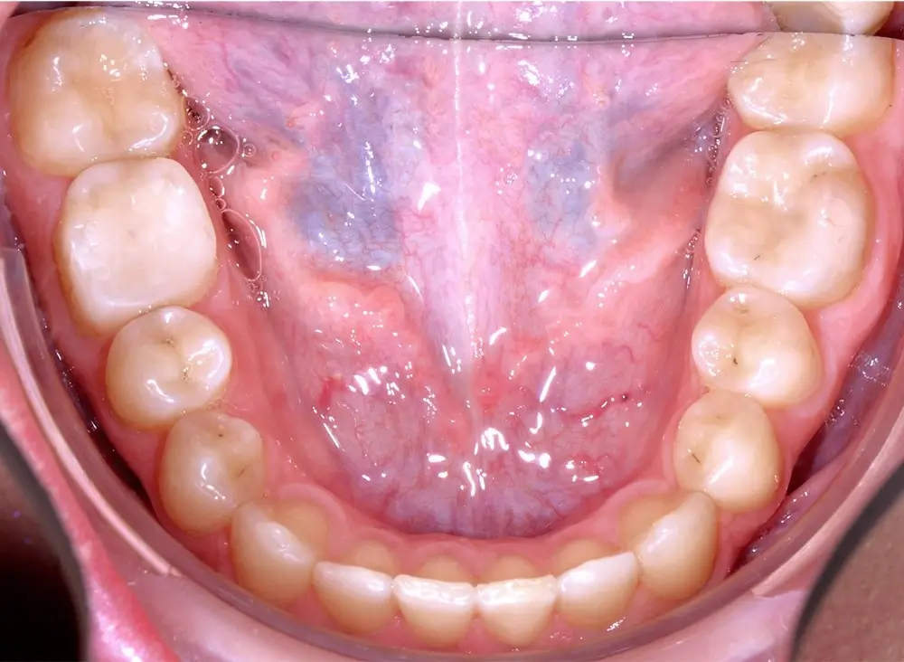 Перекрестный прикус - Кейс 8 — нижняя челюсть после лечения