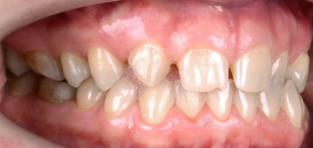 Перекрестный прикус - Кейс 8 — боковой ракурс до лечения