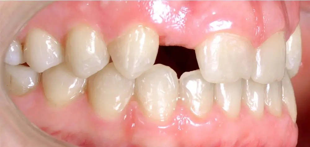 Перекрестный прикус - Кейс 8 — боковой ракурс после лечения