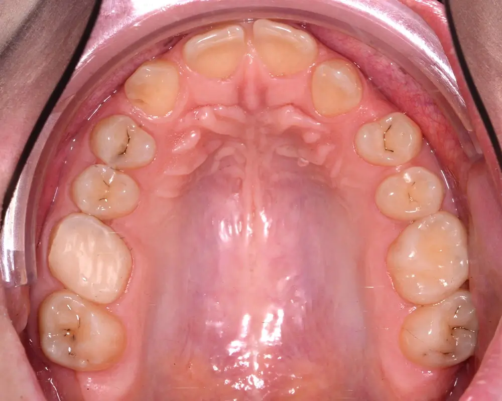 Перекрестный прикус - Кейс 8 — верхняя челюсть до лечения