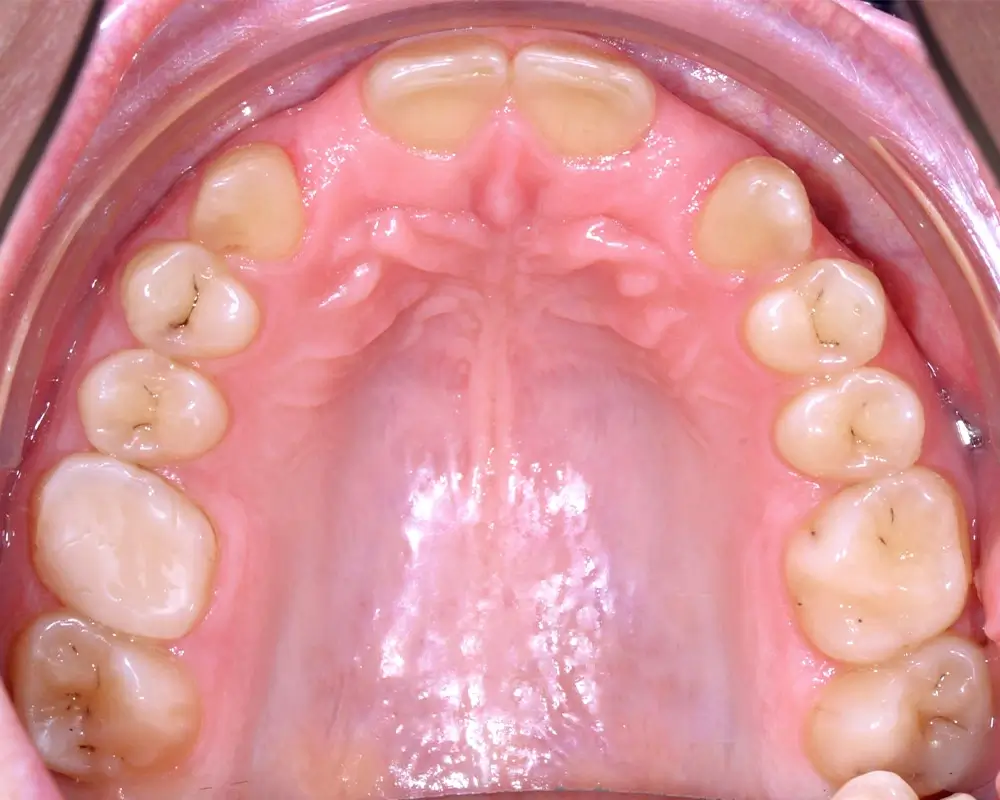Перекрестный прикус - Кейс 8 — верхняя челюсть после лечения