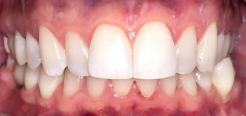 Перекрестный прикус - Кейс 9 — вид спереди до лечения