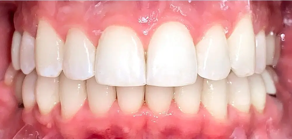 Перекрестный прикус - Кейс 9 — вид спереди после лечения