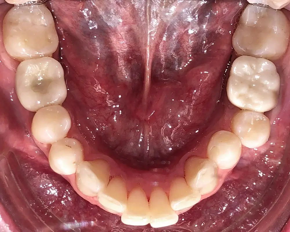 Перекрестный прикус - Кейс 9 — нижняя челюсть до лечения