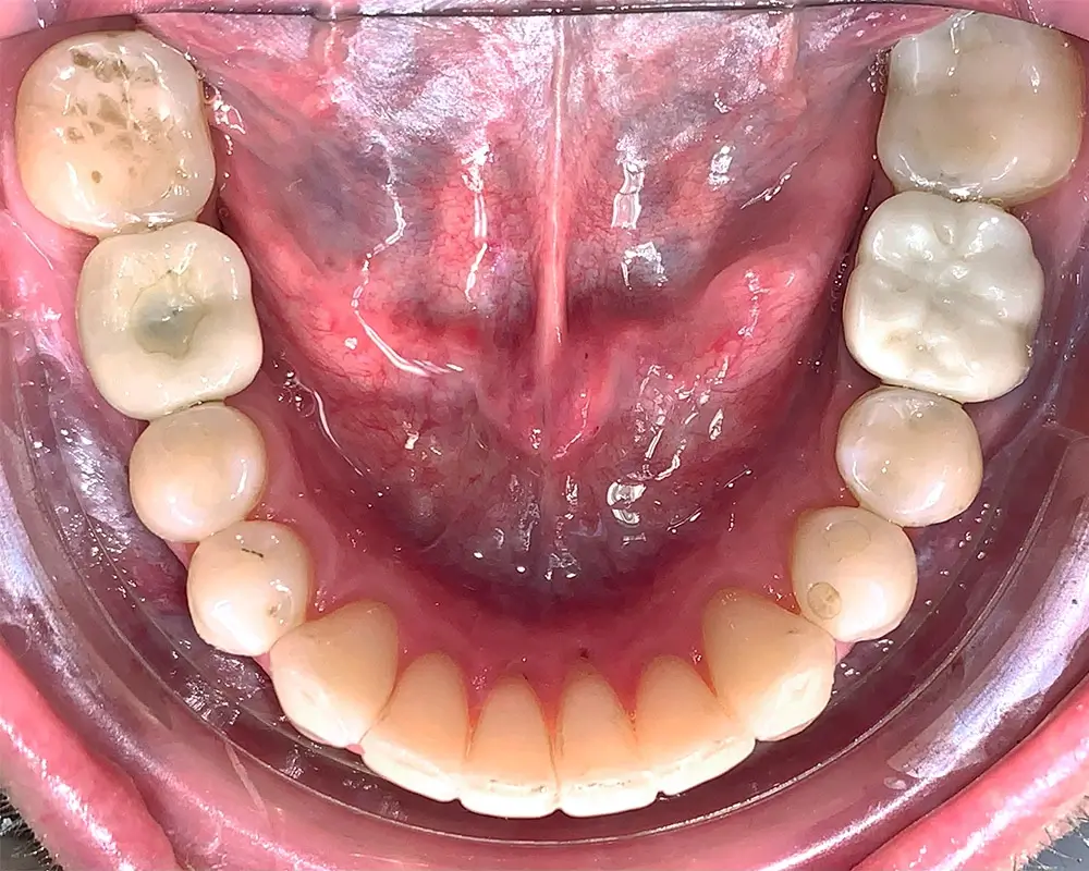 Перекрестный прикус - Кейс 9 — нижняя челюсть после лечения